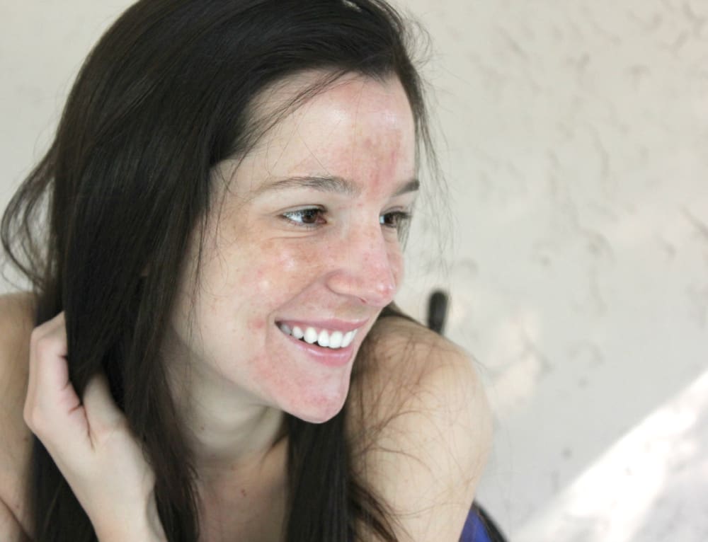Galderma Rosacea, Rosacea, Skin Care, Stephanie Ziajka, Diary of a Debutante