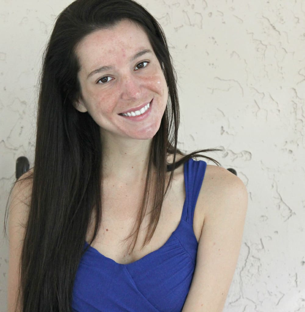 Galderma Rosacea, Rosacea, Skin Care, Stephanie Ziajka, Diary of a Debutante